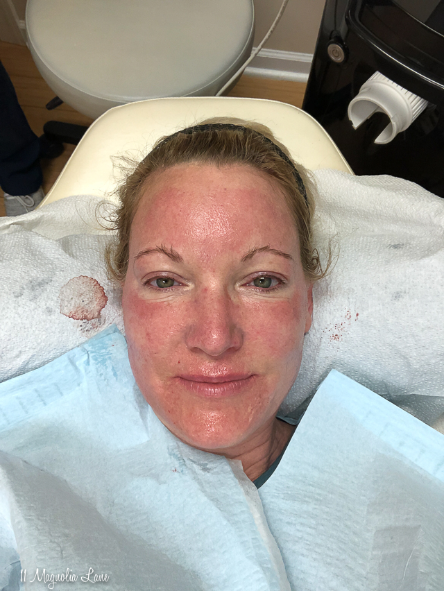 Before and afters from my Morpheus 8 procedure | 11 Magnolia Lane